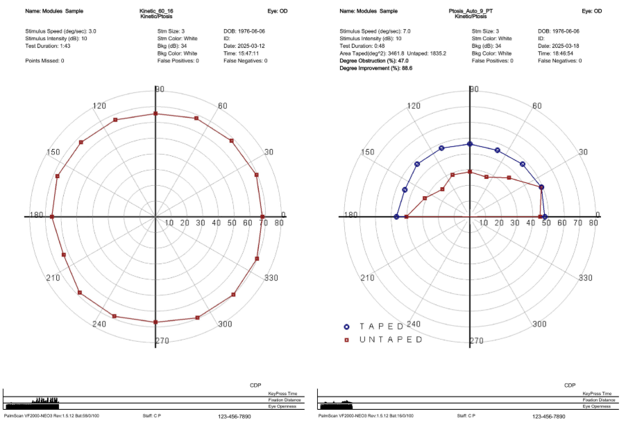 DIAGNOSTIC SPOTLIGHT: Kinetic Visual Field Testing