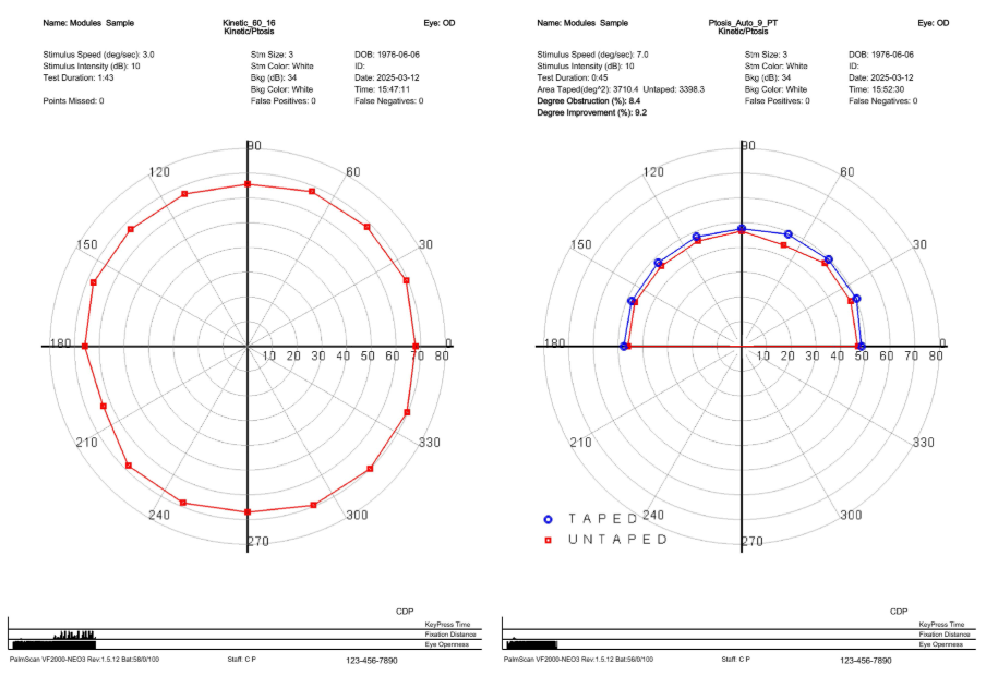 DIAGNOSTIC SPOTLIGHT:  Kinetic Visual Field Testing