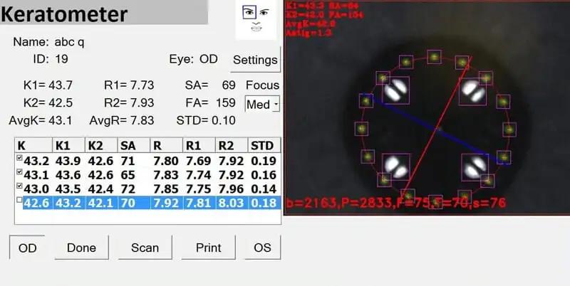 A keratometer screen displays corneal measurements and values in a table on the left, and a circular diagram with highlighted markers and colored lines on the right, used for eye assessment.