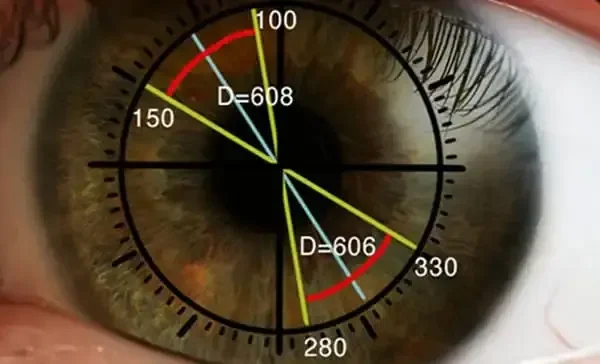 A close-up of a brown eye with overlaid angle measurements, lines, and numbers marking 100, 150, 280, and 330 degrees, as well as two distances labeled D=608 and D=606.